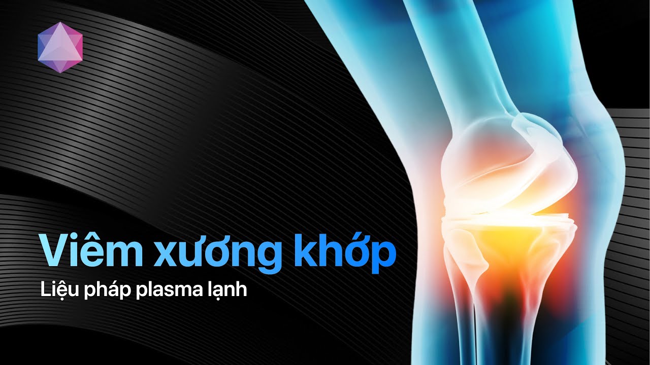 Hỗ trợ điều trị Viêm Xương Khớp bằng liệu pháp Plasma Lạnh